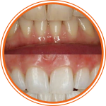 blanqueamiento dental sin dolor en villaviciosa de odon, mostoles, alcorcon. Clínica dental el bosque, Nanohidroxiapatita_1_