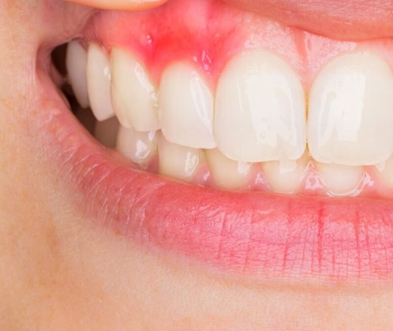 Enfermedades de las encías